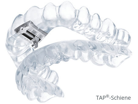 TAP®-Schiene gegen scharchen; Bild Copyright SCHEU-DENTAL GmbH, www.tap-schiene.de